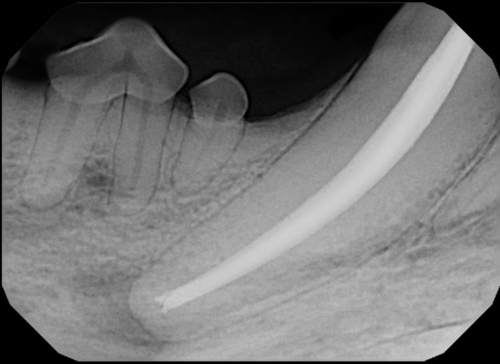 Root-Canal-Therapy-2-root-canal-canine