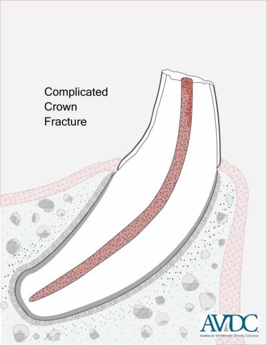 Root-Canal-Therapy-3-Complicated_Crown_Fracture_diagram-scaled
